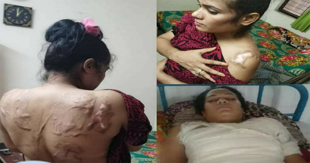 কুপ্রস্তাবে রাজি না হওয়ায় এসিড নিক্ষেপ