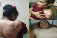 কুপ্রস্তাবে রাজি না হওয়ায় এসিড নিক্ষেপ